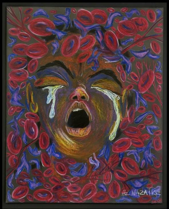 Painting by Hertz Nazaire: a face crying out, surrounded by red blood cells and blue sickled cells