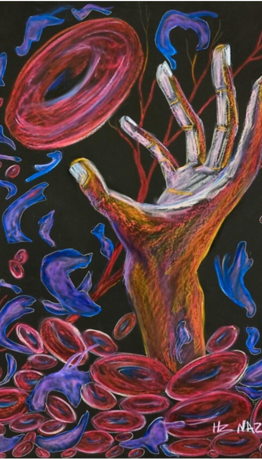 Painting by Hertz Nazaire: a hand reaching upward through a field of red blood cells and blue sickled cells